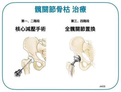 為什麼會骨枯|髖關節骨枯：成因與治療